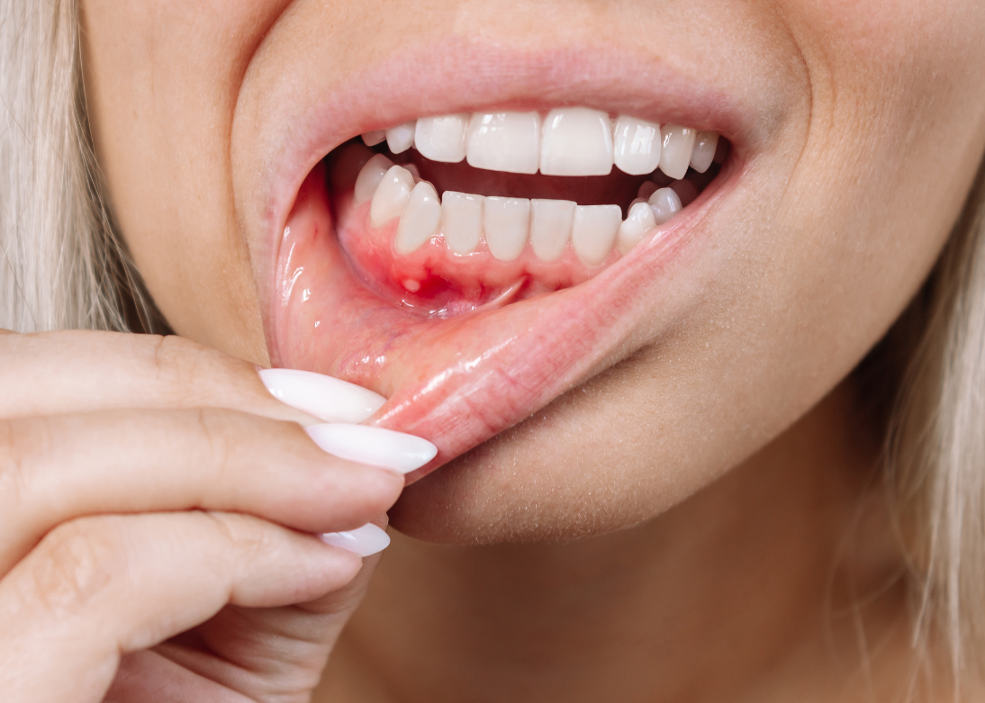 Gum Disease Treatment