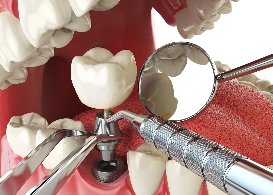 Dental Implants